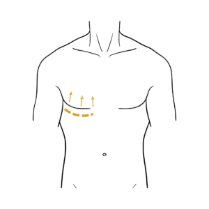 Man's body illustration highlighting the location of the Gynecomastia