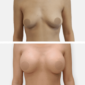 تكبير الثدي تكبير الصدر تجميل الصدر