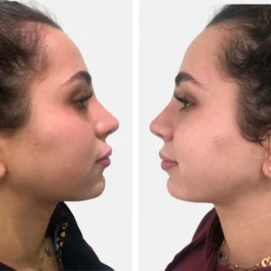 تجميل الأنف عملية تجميل الأنف تجميل الانف تجميل الخشم