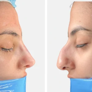 تجميل الأنف عملية تجميل الأنف تجميل الانف تجميل الخشم