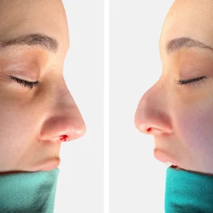 تجميل الأنف عملية تجميل الأنف تجميل الانف تجميل الخشم